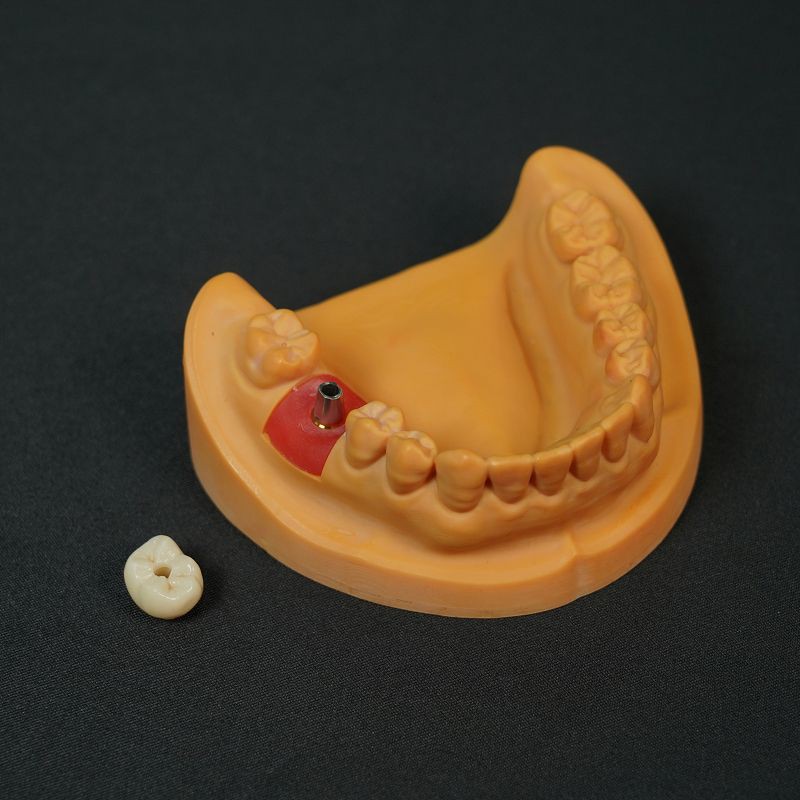 Pugin Porcelain Dental Implant